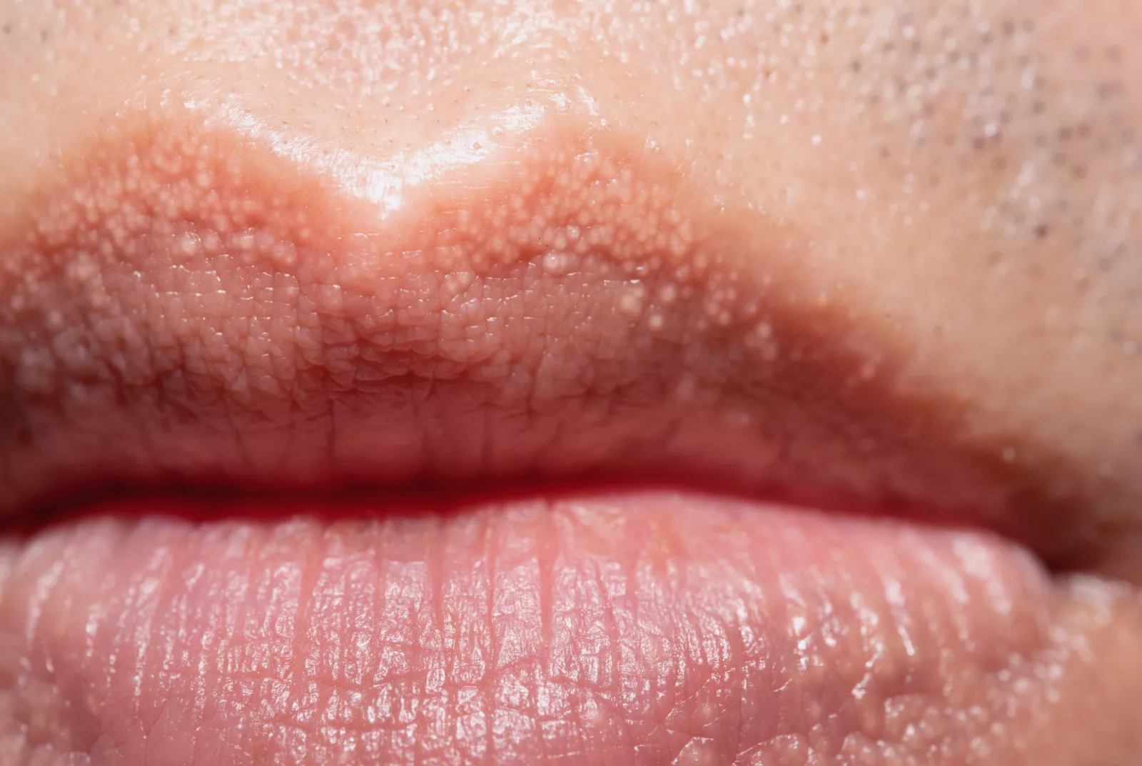 Close-up illustration of common, harmless skin bumps on the labia.