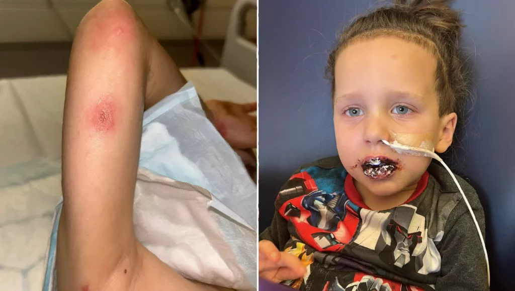 Blisters and swelling on a child’s mouth and lips inside a hospital room