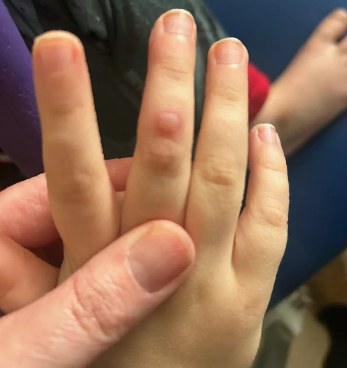 Mother holding a bowl to catch drool from her son with severe mouth blisters