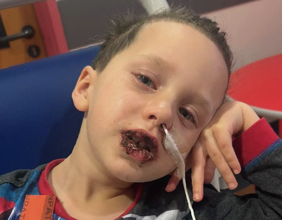 Child with healed lesions at home, playing with a football after hospital discharge
