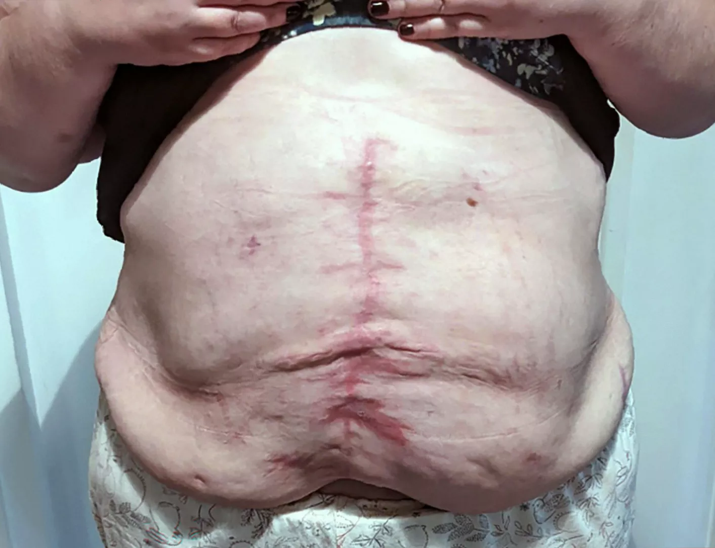 Illustration of a hernia protruding through abdominal wall muscle.