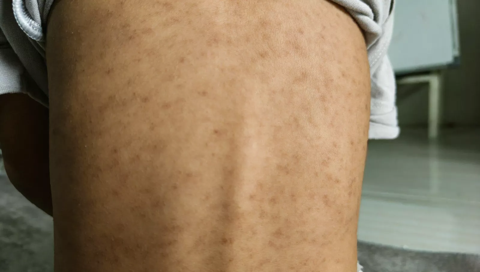 Health officials conducting contact tracing to contain measles spread after christening gathering