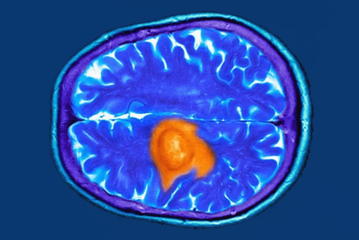 Medical researcher analysing brain imaging data in a laboratory