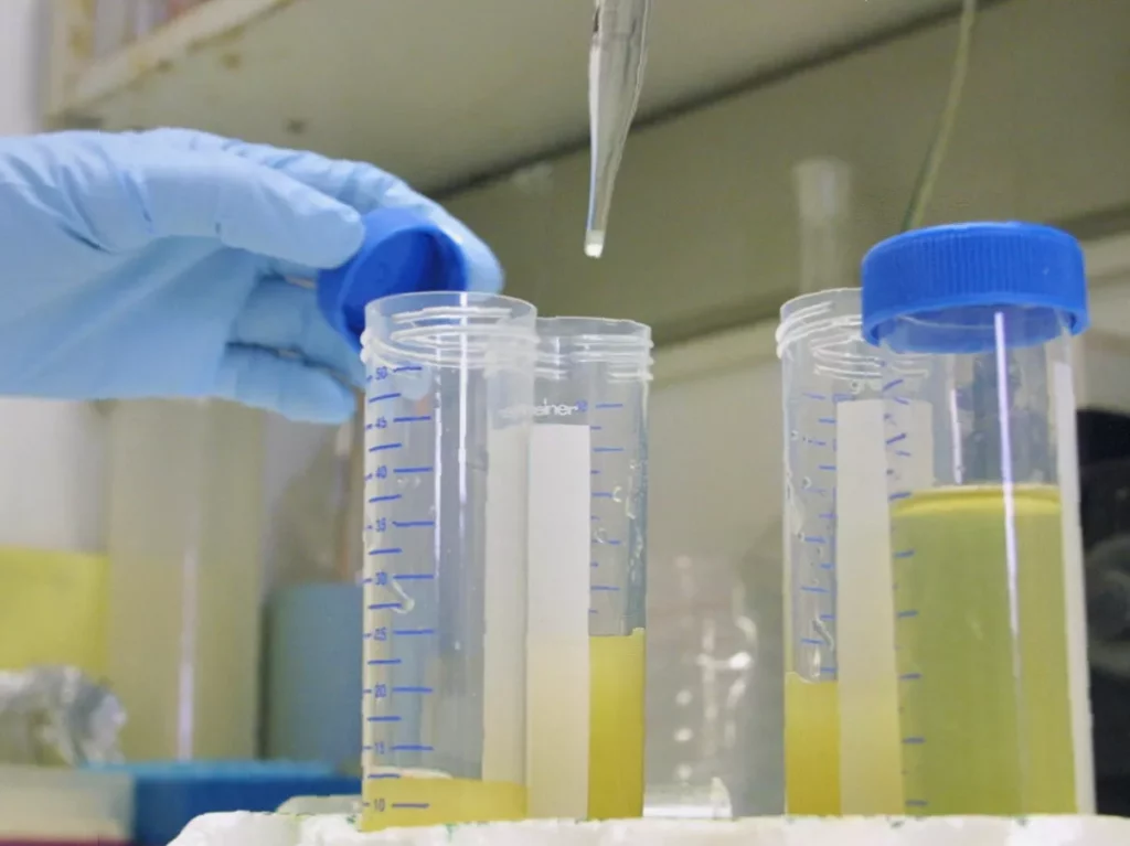 Urine test able to flag cancer at early stage could reach NHS within years Scientist holding a vial of urine sample in a laboratory for cancer research