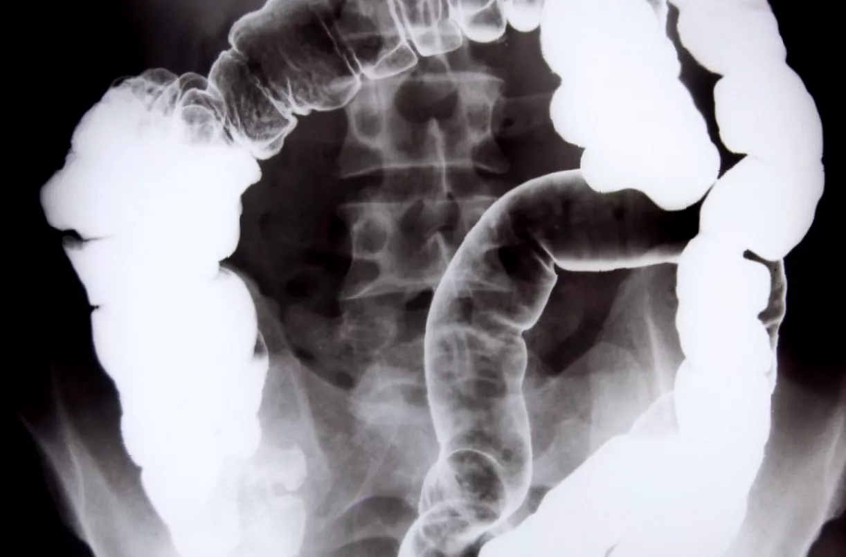 Medical diagram showing the progression of colon cancer from the bowel to the liver.
