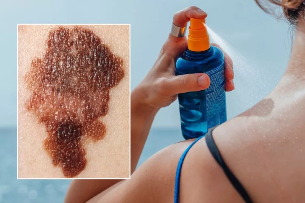 Men’s skin cancer risk three times higher if sunscreen misses one body part, doctor warns A man applying sunscreen to the back of his neck in a sunny outdoor setting