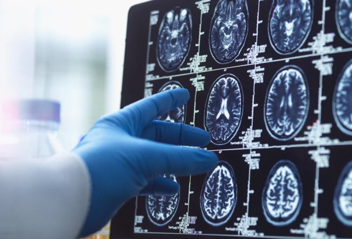 Brain scan image showing amyloid plaque build-up characteristic of Alzheimer's disease