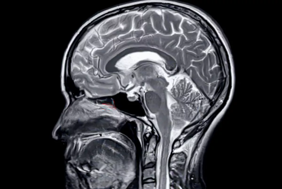 MRI brain scan showing signs of cognitive decline in an elderly patient