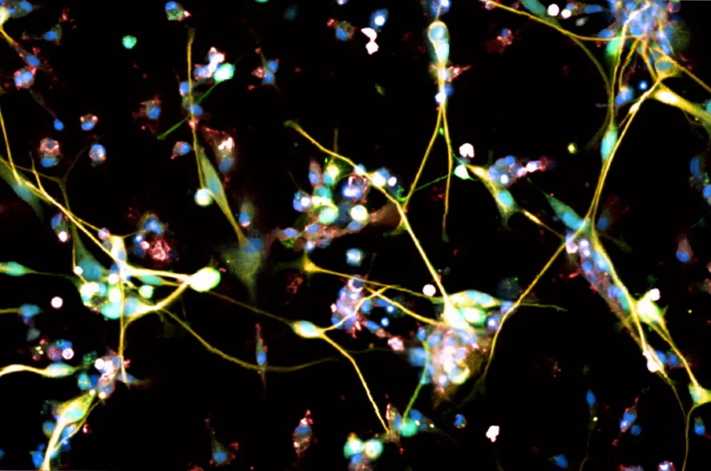 Laboratory researcher examining glioblastoma cell models under a microscope